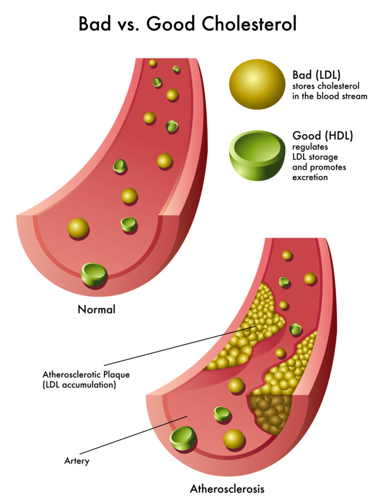 LDL vs HDL Cholesterol